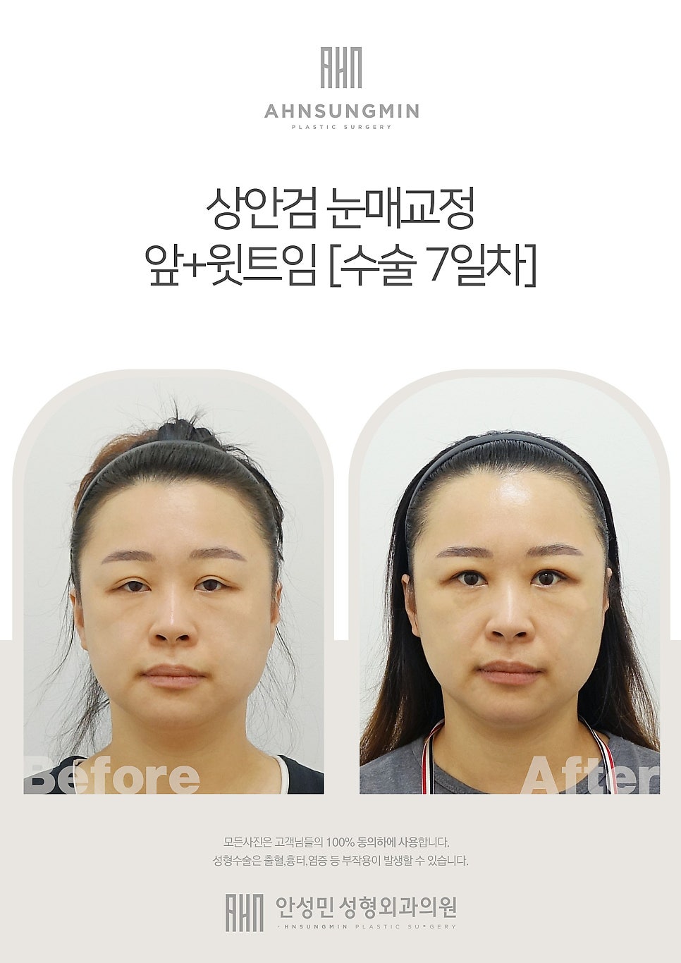 [안성민 성형외과]상안검눈매교정(재수술)+앞윗트임고객님! 관련 이미지 1
