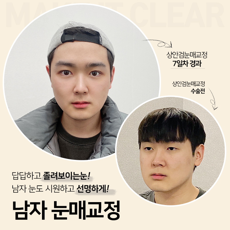 [잠실동성형외과] 남자 쌍꺼풀수술 궁금하시죠? 남자분들도 믿고 찾는 잠실성형외과 안성민성형외과 관련 이미지 1