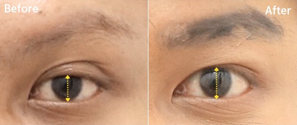 소세지눈 쌍꺼풀 풀기 재수술로 해결 관련 이미지 5