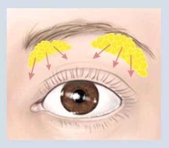 상안검 수술의 모든 것 관련 이미지 3