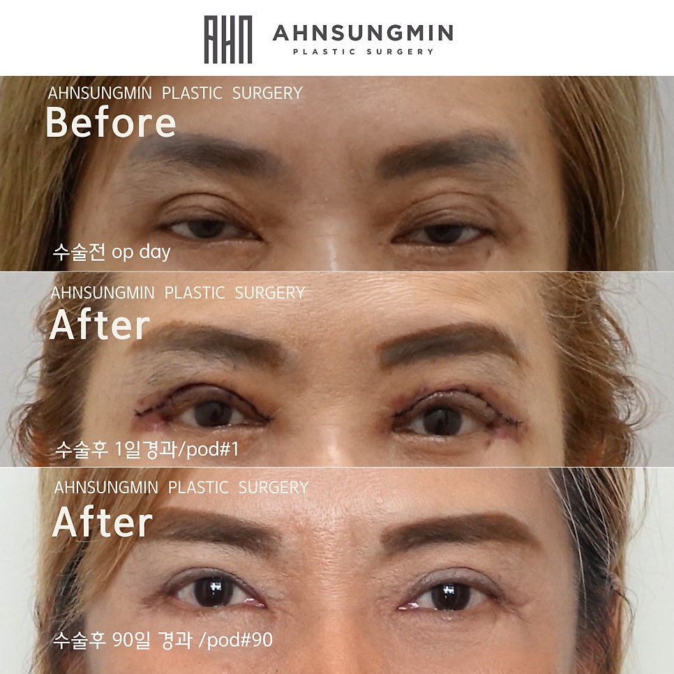 눈재수술전문 재수술이 어려운 이유 관련 이미지 6