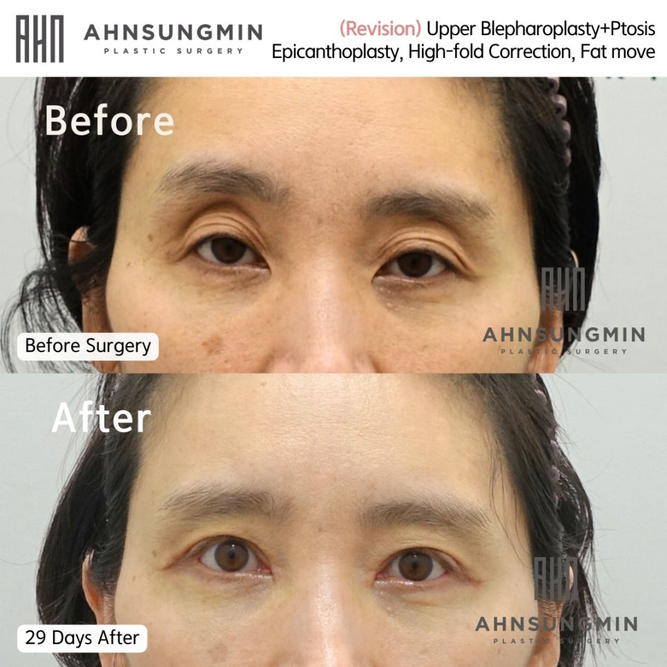 눈재수술 전문 꺼진눈 지방성형 성형외과 전문의 관련 이미지 2