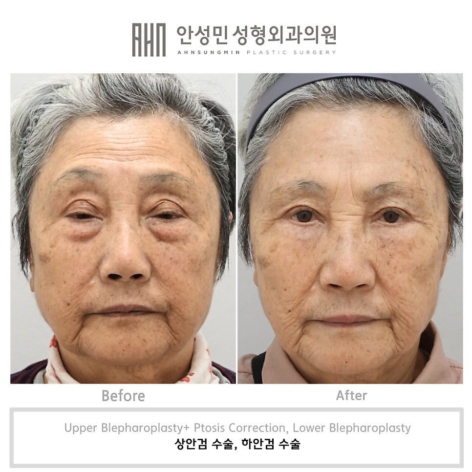 하안검 교정술과 중안면 거상의 중요성 관련 이미지 1
