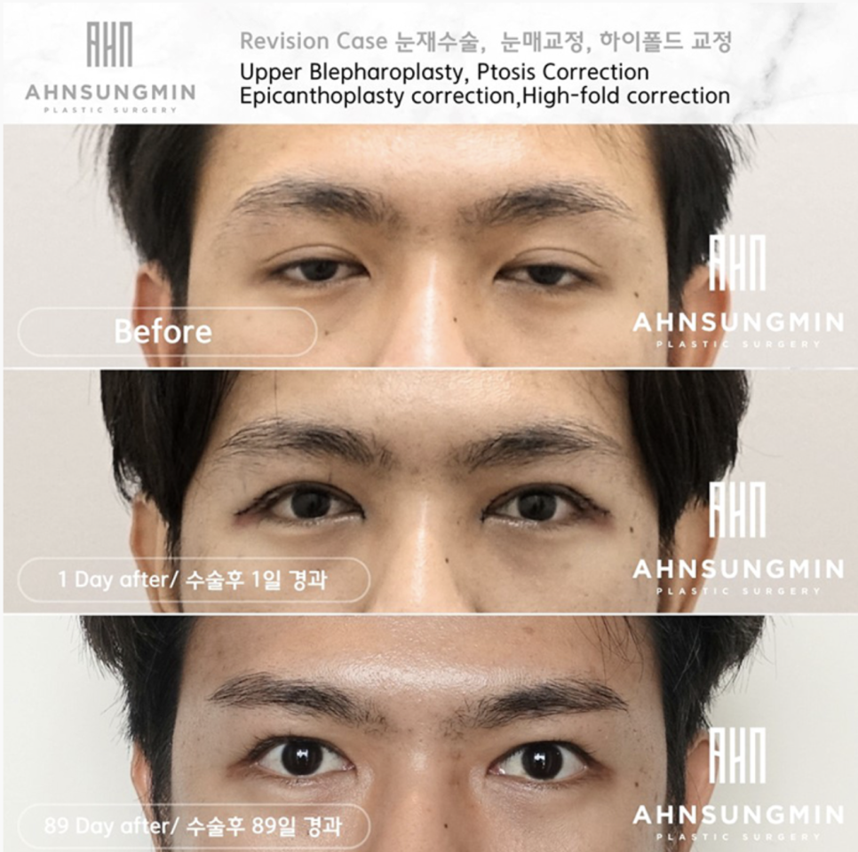 남자 눈성형 두꺼운 쌍꺼풀 풀기 관련 이미지 11
