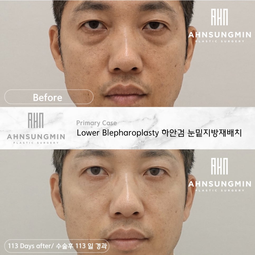 중년 남성 눈밑 지방재배치 잘하는 병원, 안성민 성형외과 관련 이미지 3