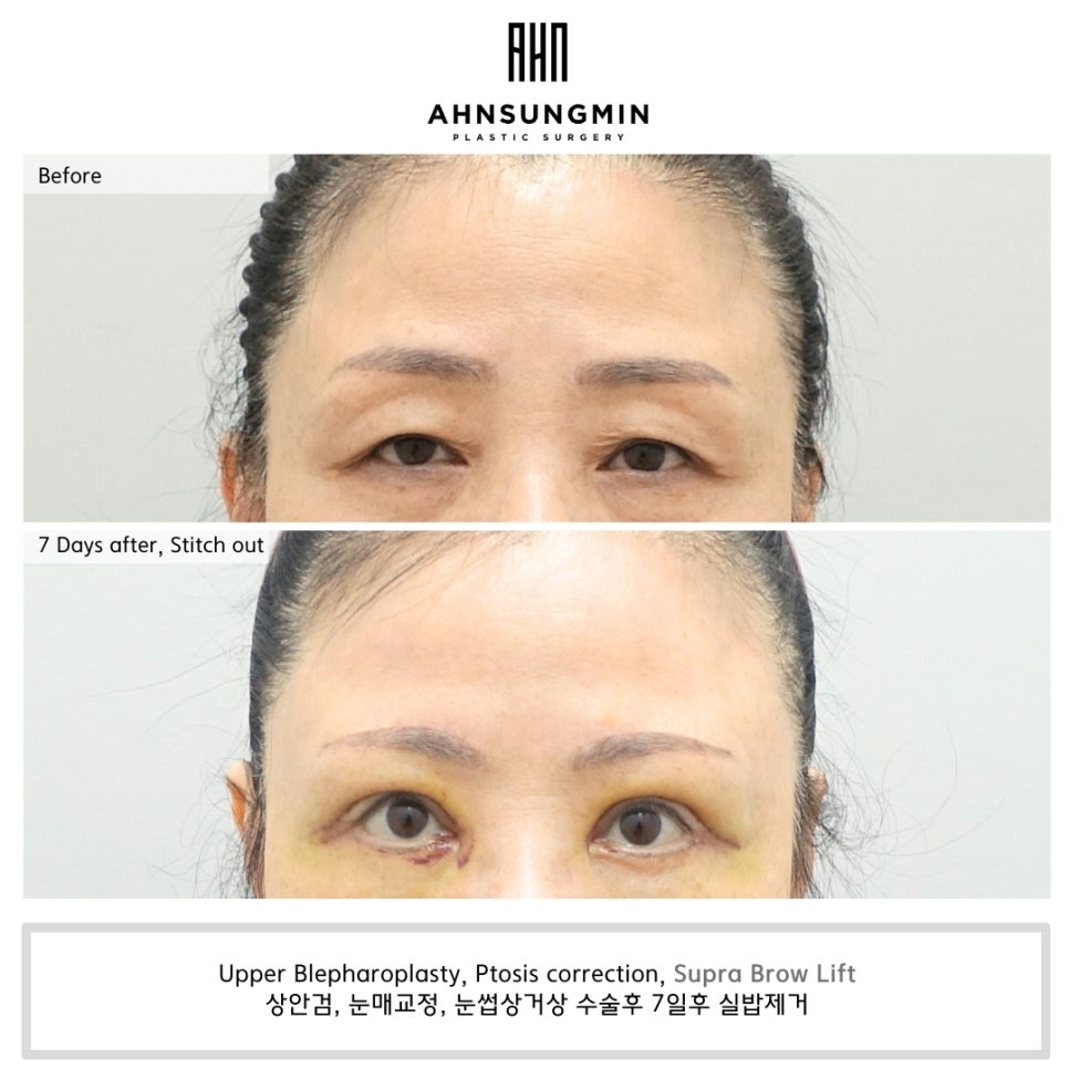 눈꺼풀 처짐의 원인과 눈썹 거상 수술이 필요한 이유 [성형외과 전문의 안성민] 관련 이미지 5