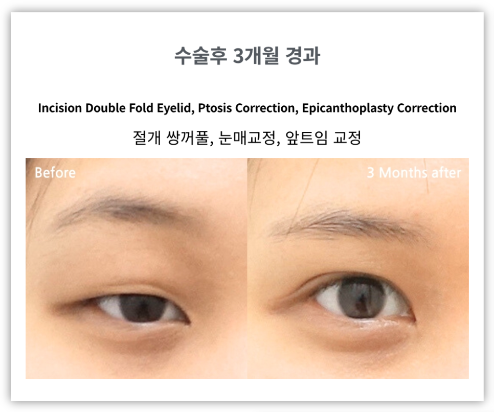 절개쌍꺼풀과 비절개쌍꺼풀 비교 관련 이미지 4