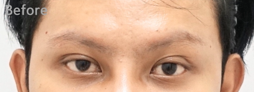 쌍꺼풀이 풀리는 이유와 교정 방법 [성형외과 전문의 안성민] 관련 이미지 2