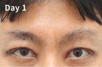 쌍꺼풀 재수술 후 눈은 언제 자연스러워질까? (Day 1부터 6개월 변화) 관련 이미지 4