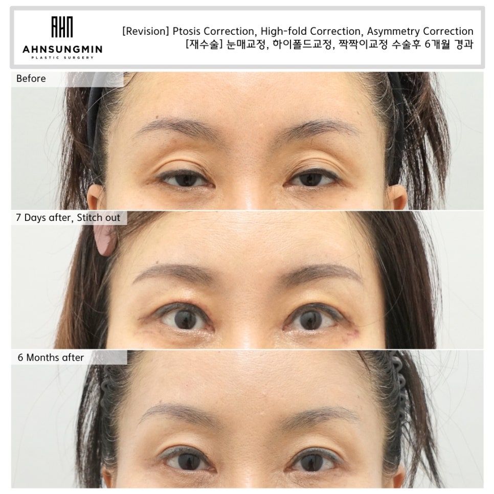 [재수술] 눈꺼풀 겹주름 어떻게 해결할까? 관련 이미지 2