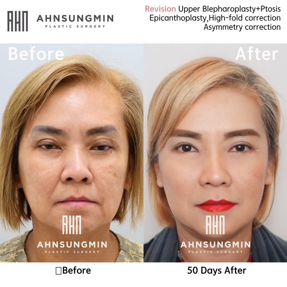 눈재수술전문 안성민성형외과 눈매교정재수술 안성민성형외과 관련 이미지 4