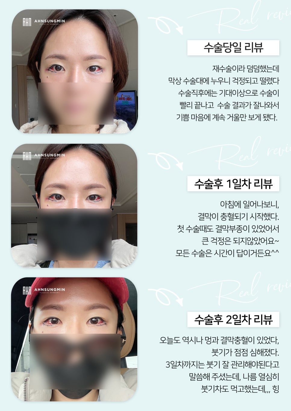 [잠실동성형외과] 듀얼트임 7일차 리얼후기 관련 이미지 2