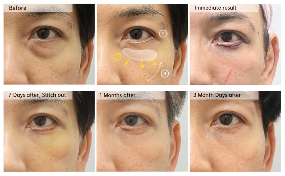 중년 남성 하안검 노화 과정과 각종 처치법 관련 이미지 2