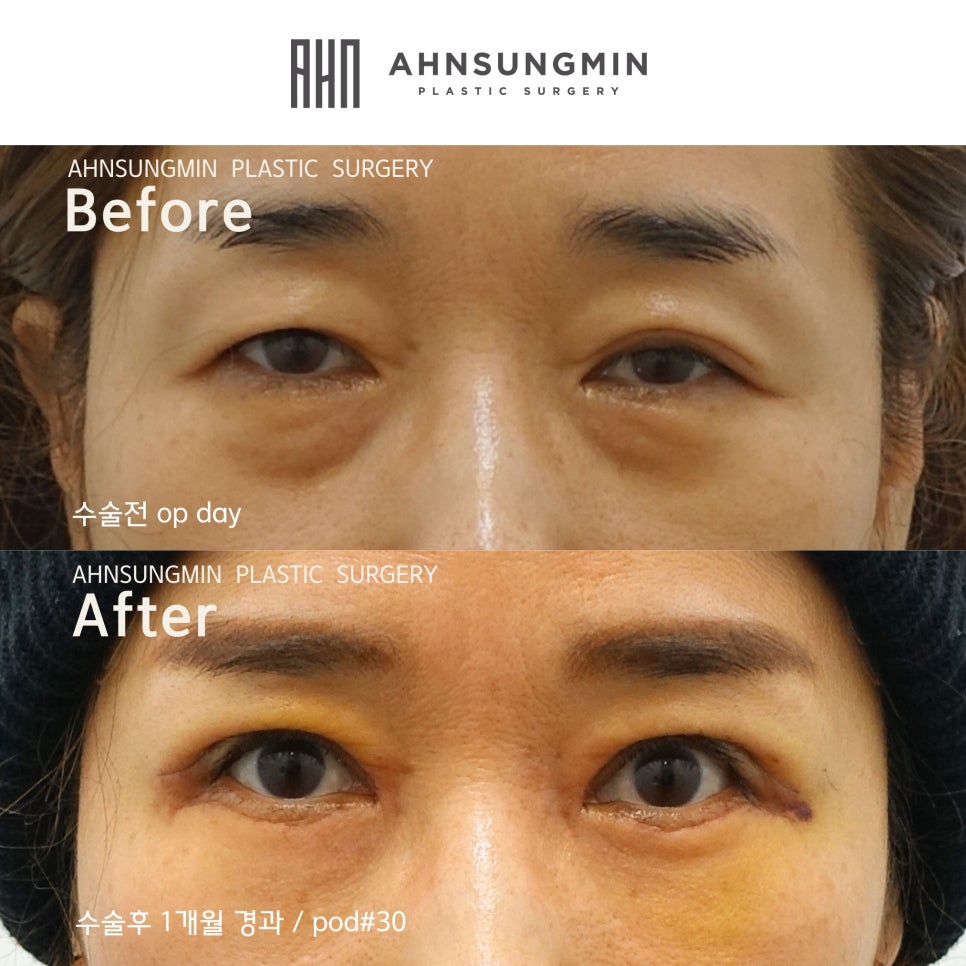 중년의 여성 눈처짐 [상안검 눈매교정,하안검 눈밑지방재배치,미니 중안면거상] 관련 이미지 2