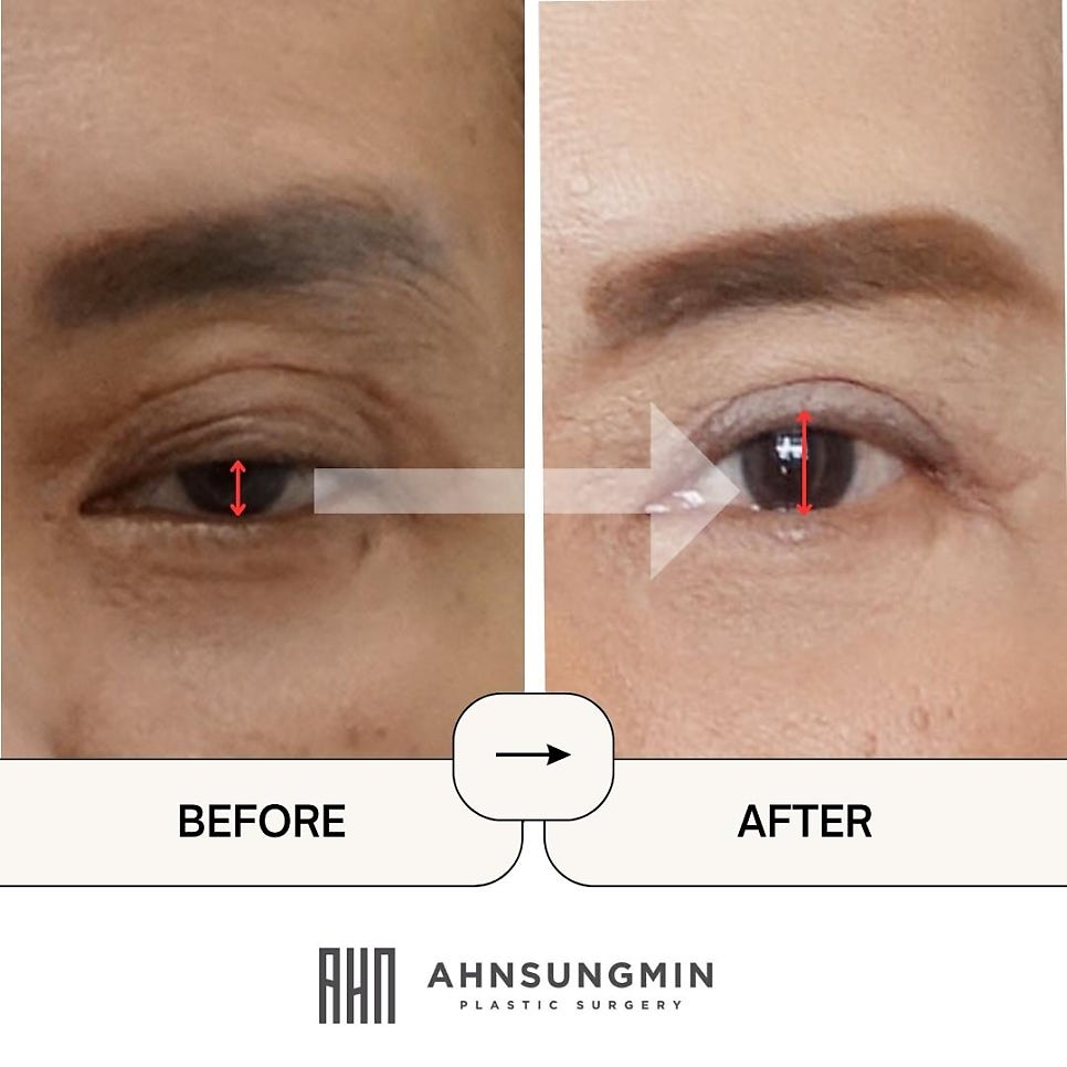 눈재수술전문 재수술이 어려운 이유 관련 이미지 5