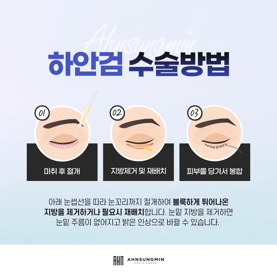 잠실성형외과칼럼 :: 상안검과 하안검 수술 구분. 관련 이미지 6