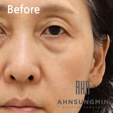 하안검 눈밑지방재배치란 무엇일까요? [지방제거를 하면 안 되는 이유] 관련 이미지 3