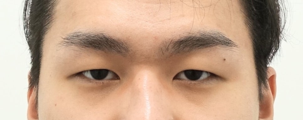 나이대별 상안검 수술 전후, 성형외과전문의 안성민 관련 이미지 5