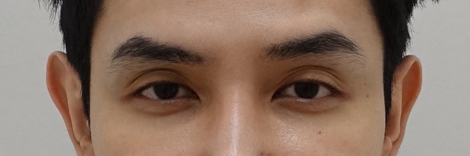 남자 안검하수 눈매교정, 20대 남자에게 어울리는 눈매교정 관련 이미지 2