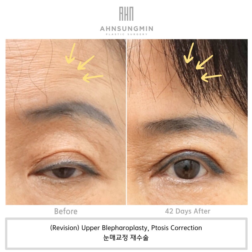 중년 눈 재수술 근본적인 문제 해결 맞춤 재수술 관련 이미지 1