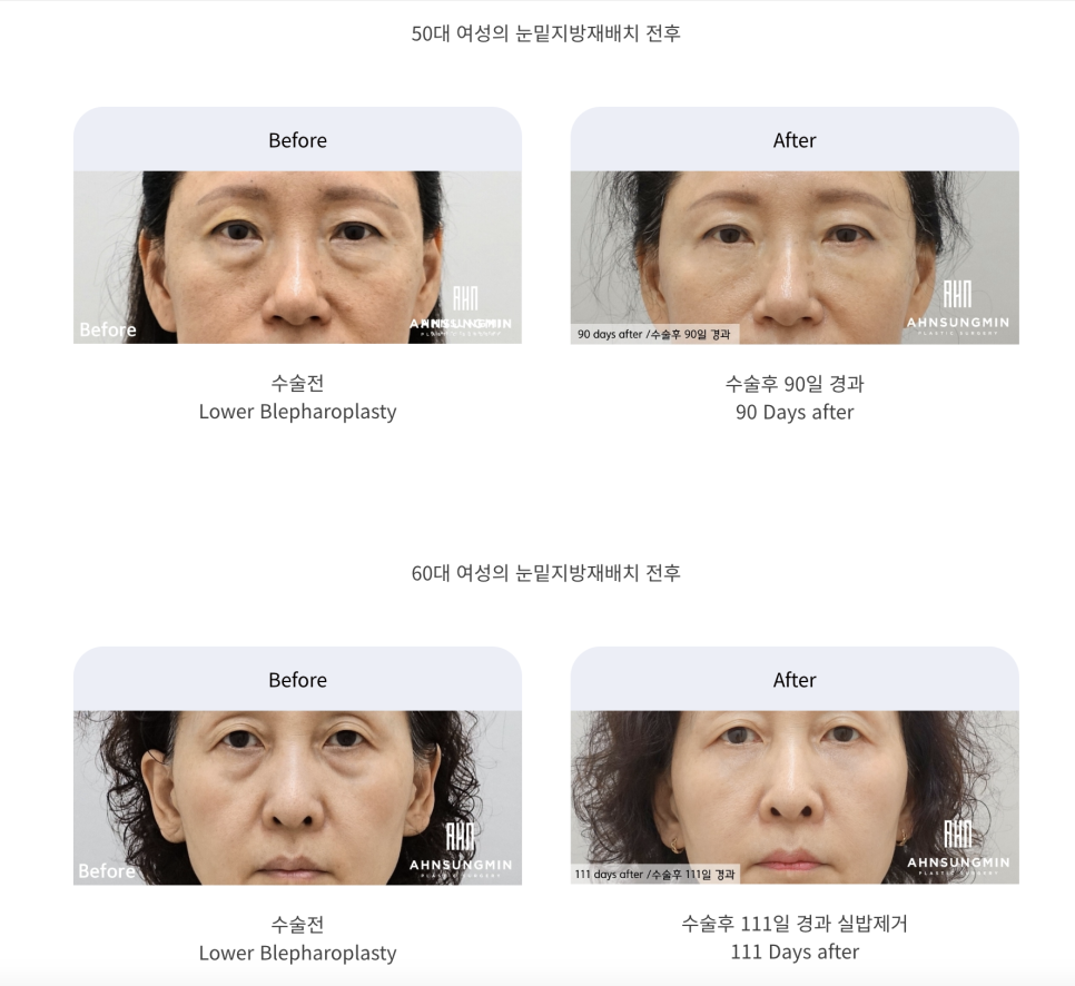 불룩한 눈 밑 지방, 해결할 수 있을까? 관련 이미지 8