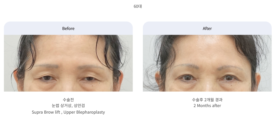 눈썹거상 수술의 장점과 나이대별 회복 과정 관련 이미지 5