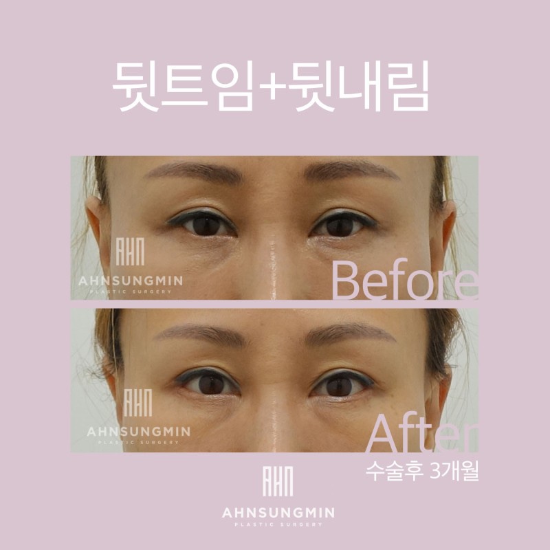 뒷트임 뒷내림 시원하고 선해 보이는 눈매교정 관련 이미지 4