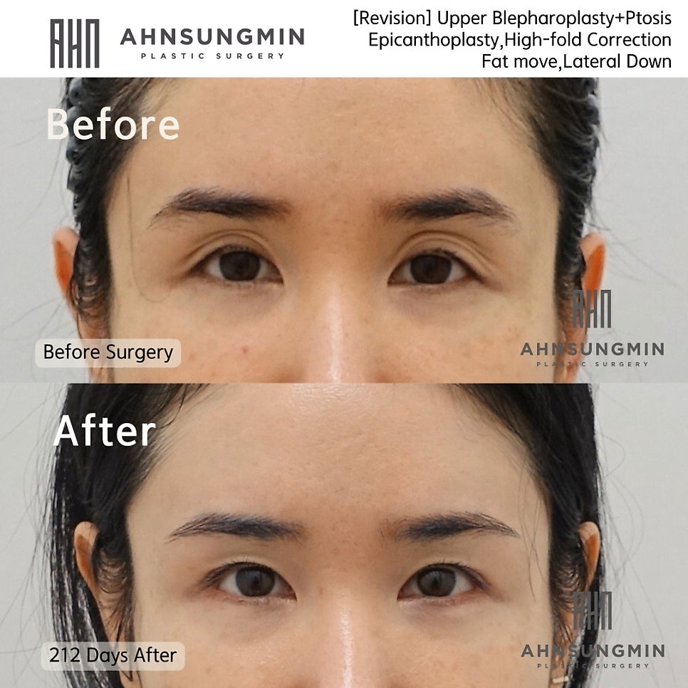 쌍커풀 재수술시 유의점 관련 이미지 2