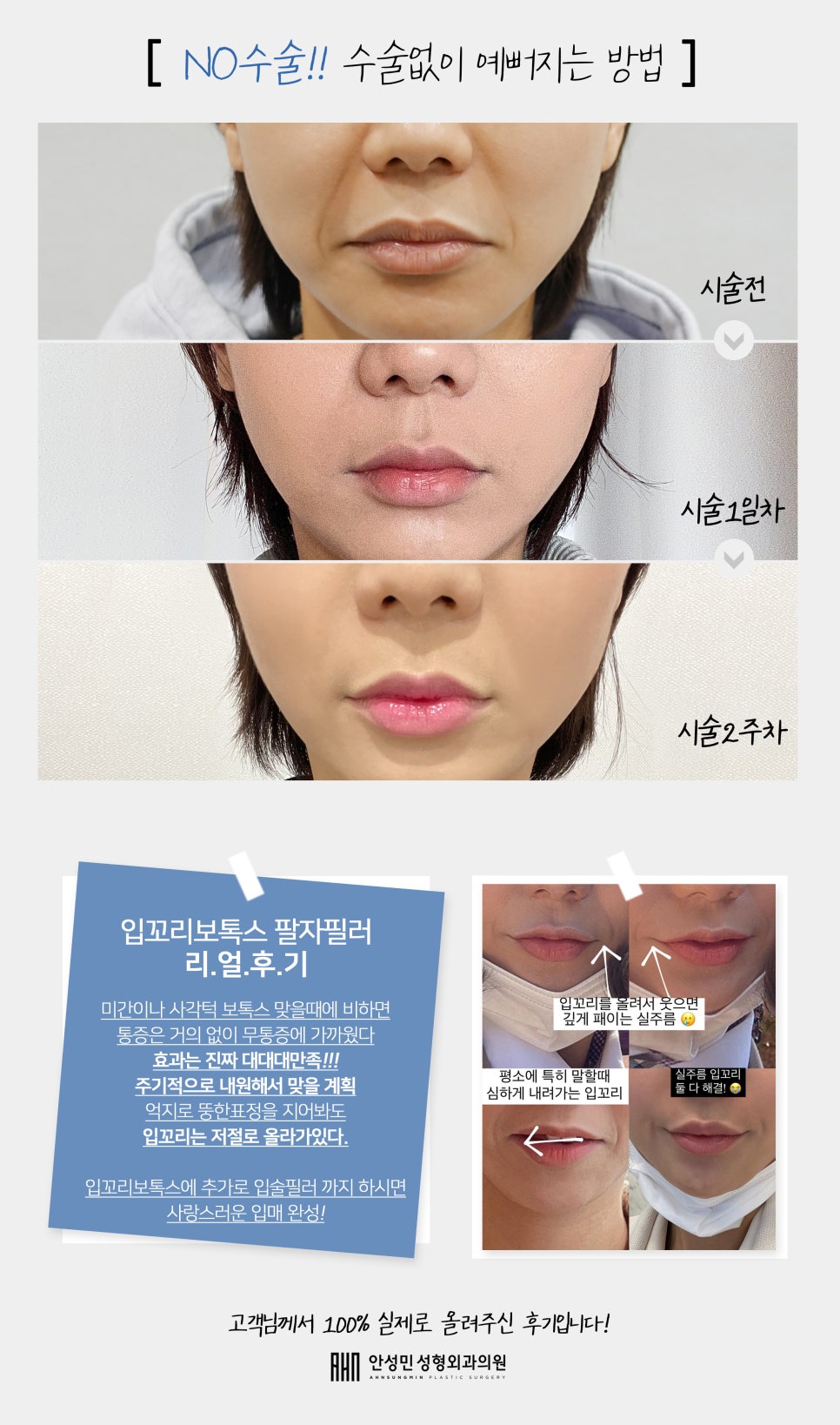 [잠실동성형외과] NO!! 수술없이 예버지는 방법! 입꼬리 보톡스 + 팔자 필러 솔직후기 2주차 리얼후기 / 잠실성형외과 관련 이미지 2