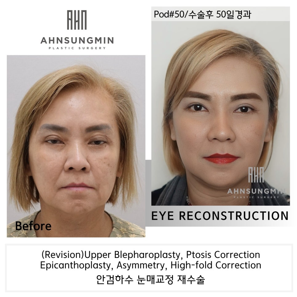 겹주름의 근본적인 원인, 눈 재수술 [성형외과 전문의 안성민] 관련 이미지 2