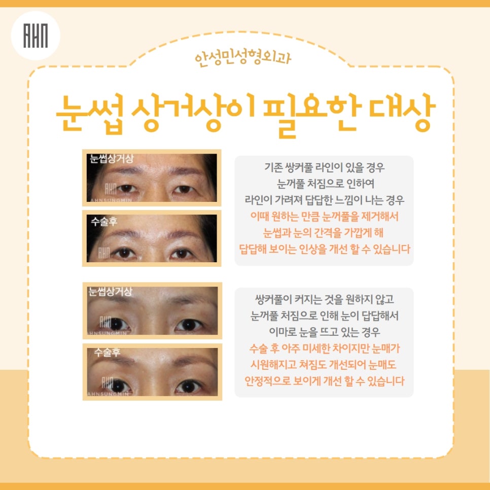 눈썹상거상 꼭 필요할까? 관련 이미지 4