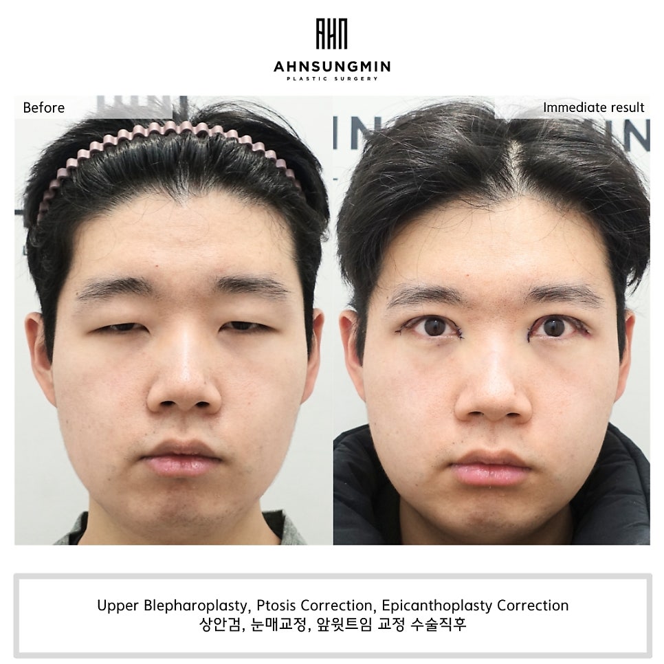 20대 남자 눈매교정 수술 직후 눈동자 노출 변화 관련 이미지 3