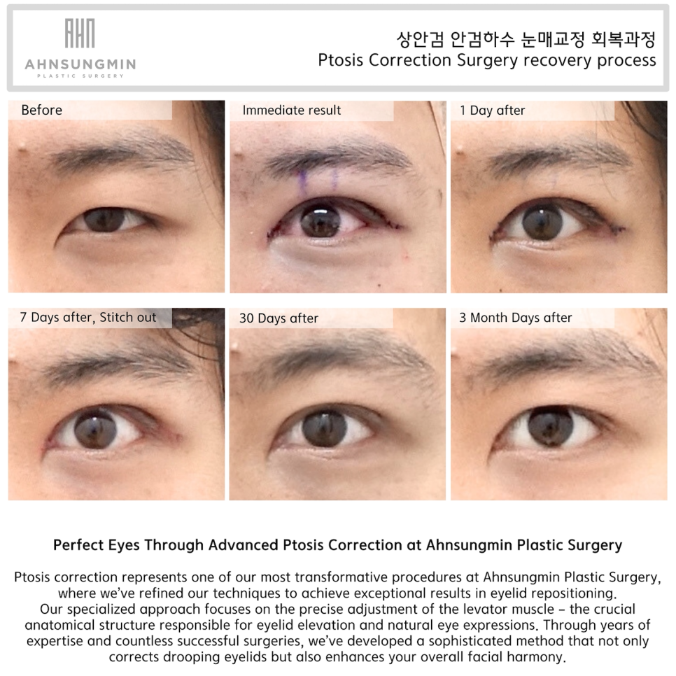 느끼한 남자눈 쌍꺼풀 낮추기 관련 이미지 3