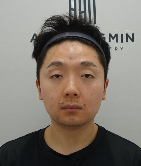 20대 남성 안검하수 증세와 눈매교정 수술 후 3개월 경과 관련 이미지 5