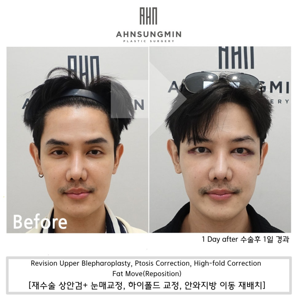 꺼진 눈 나이 들어 보이는 이유, 꺼진 눈 해결 방법 관련 이미지 6