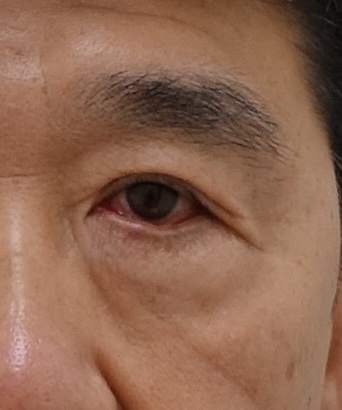 안검외반 교정 복원 전후 관련 이미지 2