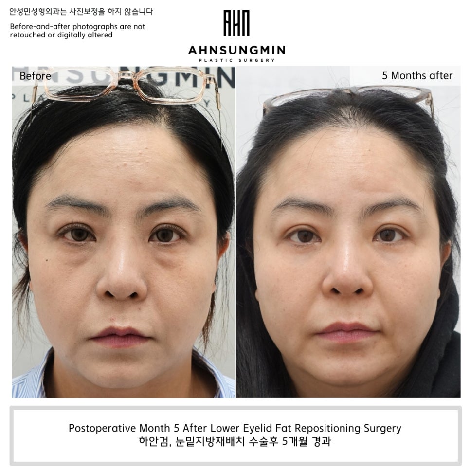 하안검 수술, 지방을 많이 제거하면 오히려 꺼질 수 있습니다 관련 이미지 1