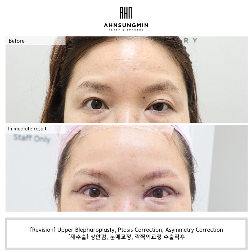 안검하수 짝짝이 교정, 헤링스법칙  [성형외과 전문의 안성민] 관련 이미지 2