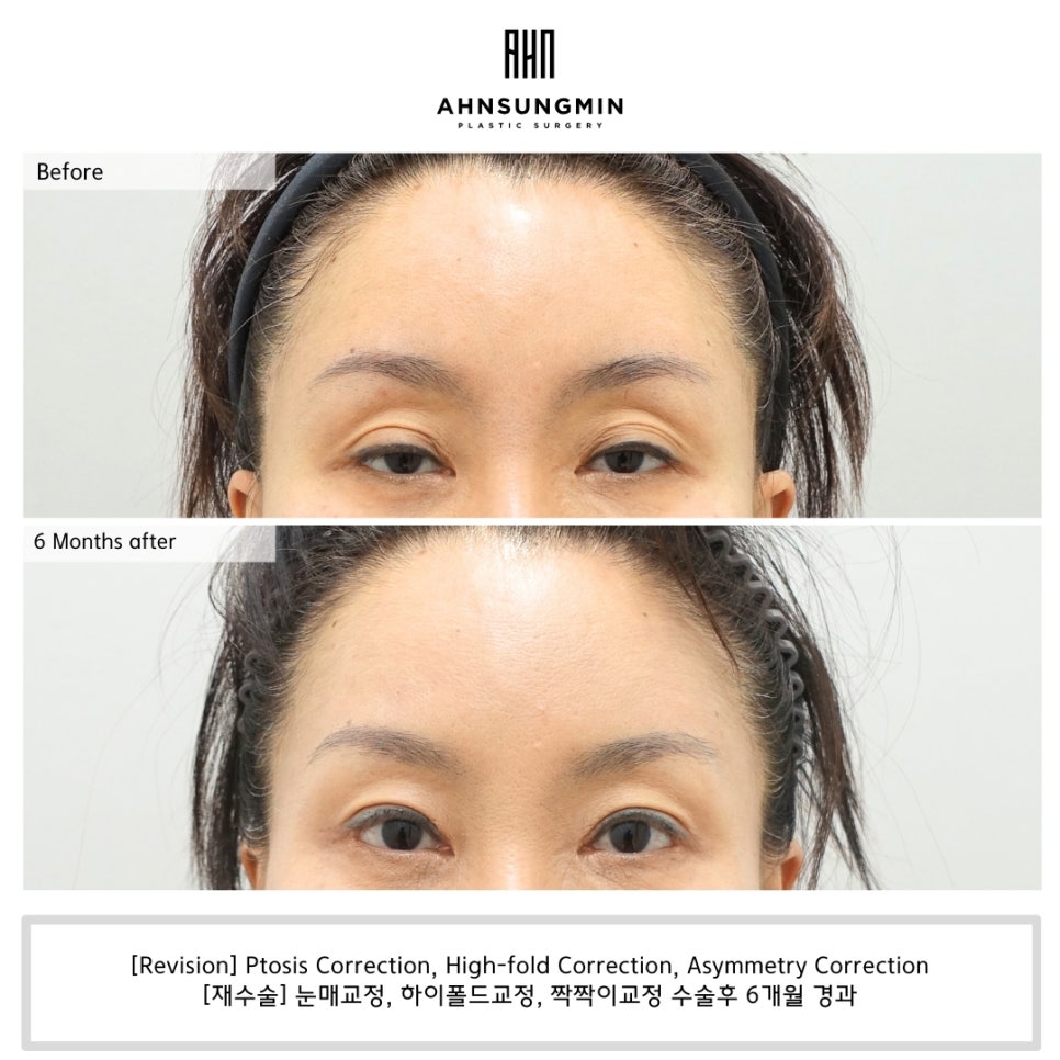 [재수술] 눈꺼풀 겹주름 어떻게 해결할까? 관련 이미지 1