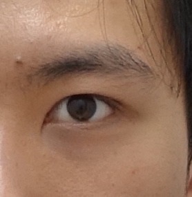 생기있는 남자 눈매완성, 안검하수 눈매교정 관련 이미지 8