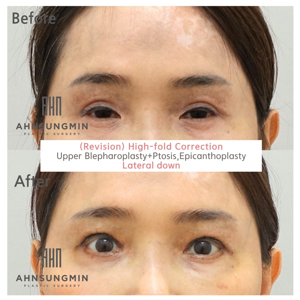 눈재수술 트임수술 반복적인 재수술의 실패이유 관련 이미지 2