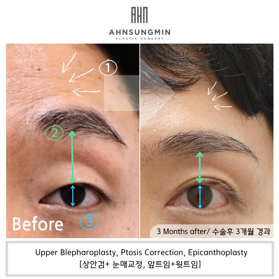 20대 남성 안검하수 증세와 눈매교정 수술 후 3개월 경과 관련 이미지 4