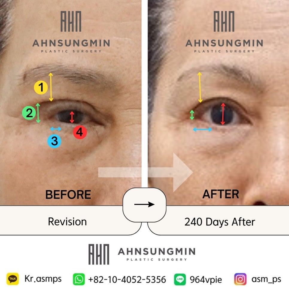 눈재수술 눈매교정재수술 트임 재수술 눈썹상거상 관련 이미지 4