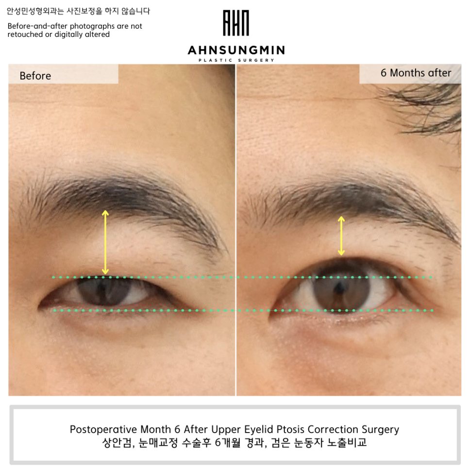 상안검, 눈매교정 수술 후 6개월 경과 &ndash; 눈뜨는 힘이 달라지면 인상이 달라집니다 관련 이미지 2