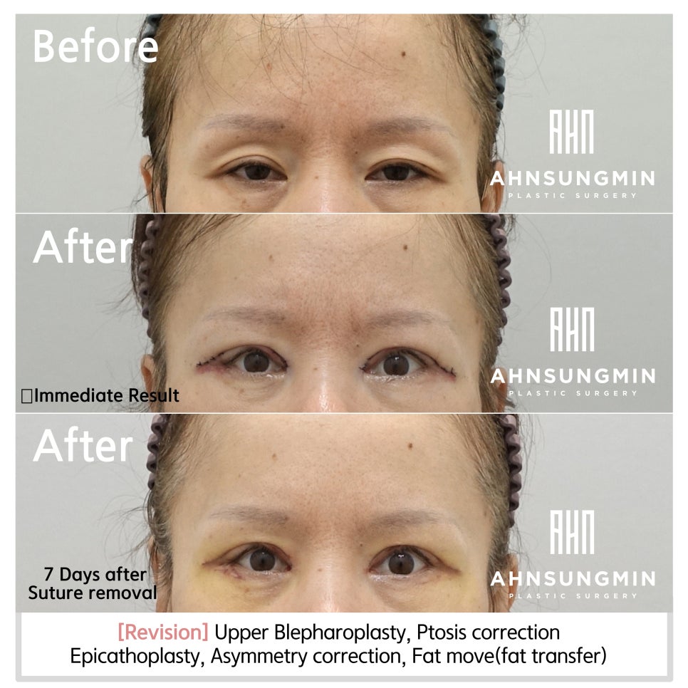 안검하수 짝짝이 교정 눈 재수술 전문 안성민성형외과 [성형외과 전문의 안성민 대표원장] 관련 이미지 2