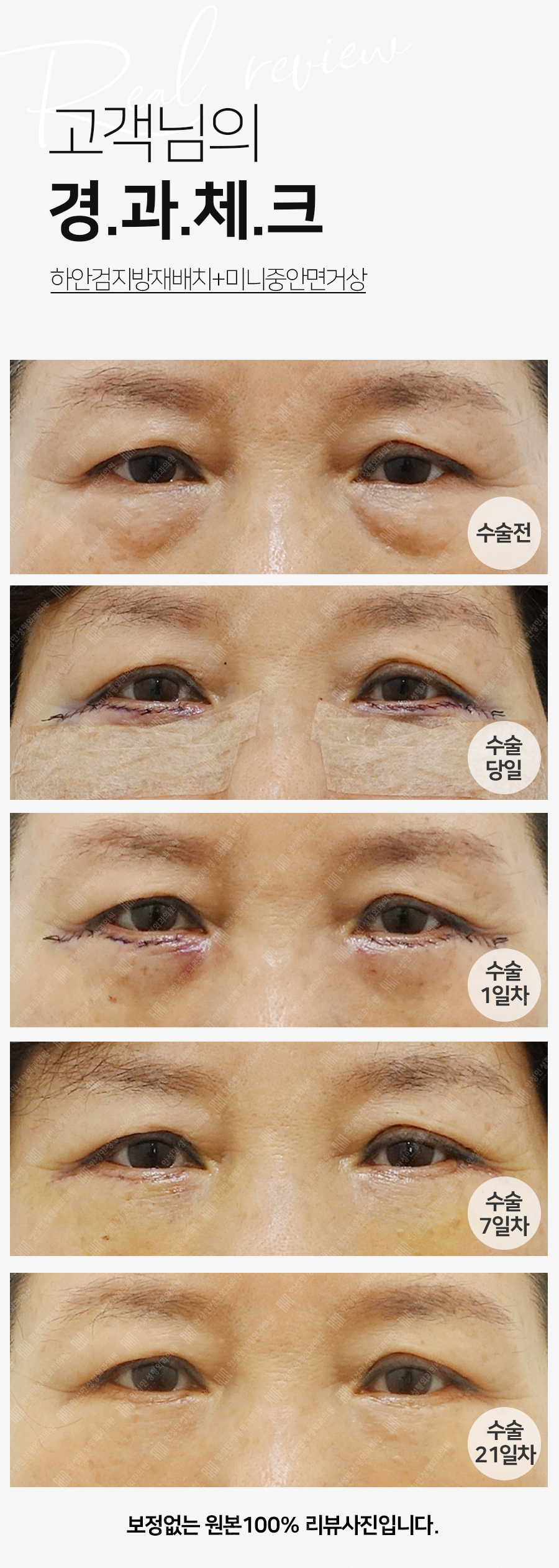 [잠실동성형외과] 하안검지방재배치+미니중안면거상 21일차 경과 총정리! 관련 이미지 1