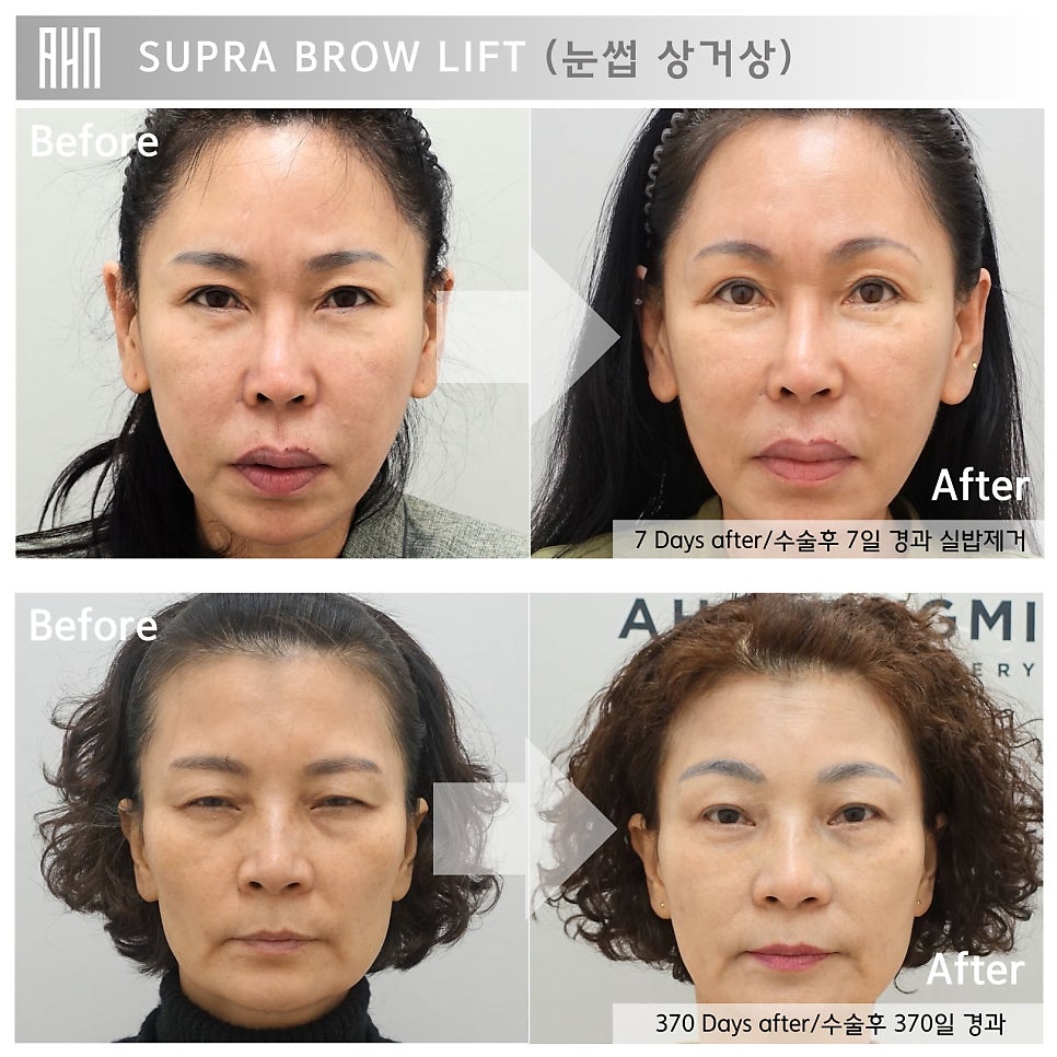 눈썹 거상 수술 후 30일 경과, 1년 경과 관련 이미지 3