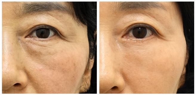 하안검 지방재배치 재수술, 정말 가능한가요? 관련 이미지 6