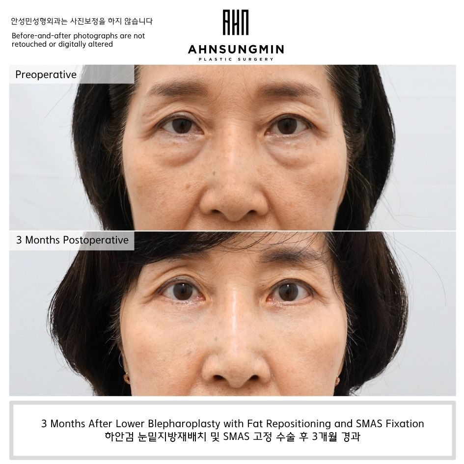 Lower Eyelid Surgery Recovery Process: How Natural Does It Actually Become? image 1