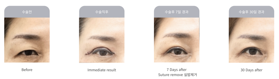 나이대별 상안검 수술 전후, 성형외과전문의 안성민 관련 이미지 2